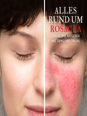 cover image of Alles Rund um Rosacea--Der kleine Ratgeber mit Tipps und Tricks